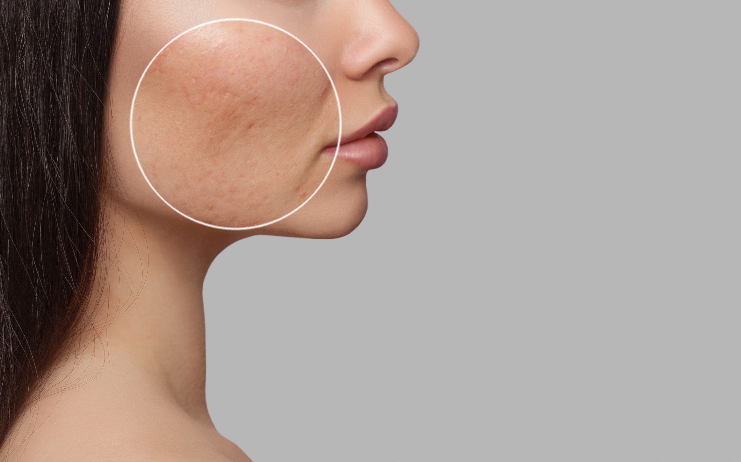 The Truth About What Works for Acne Scars
