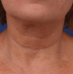 after RF microneedling