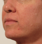 After RF Microneedling
