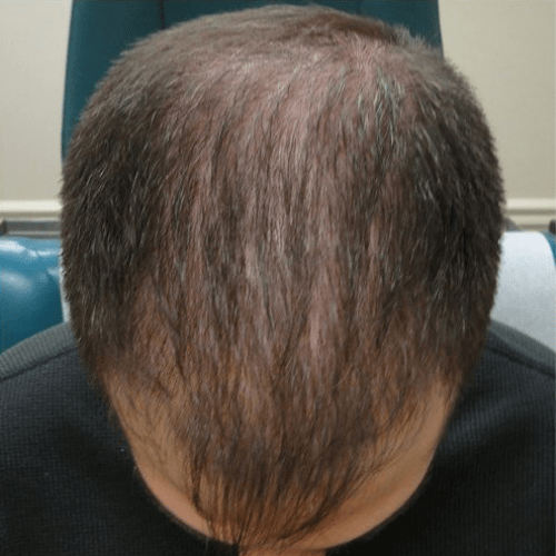 after PRP Hair Loss Treatment
