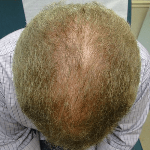 before PRP Hair Loss Treatment