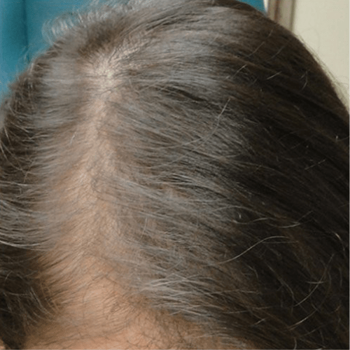 after PRP Hair Loss Treatment