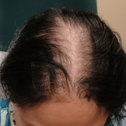 before PRP Hair Loss Treatment