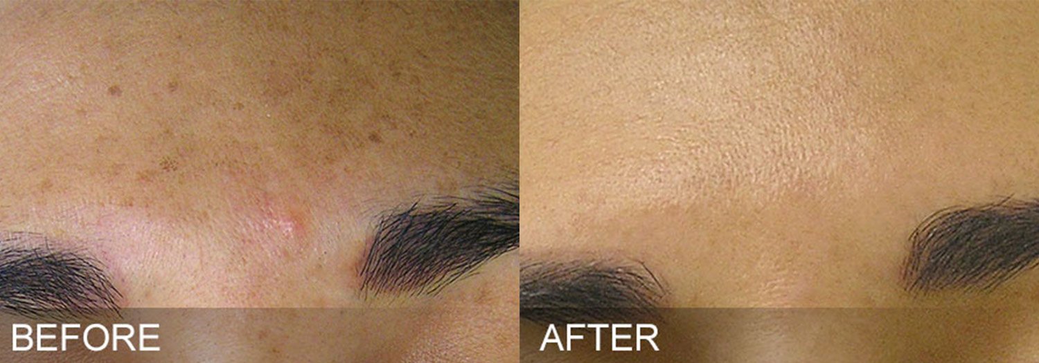 Hydrafacial Before and After